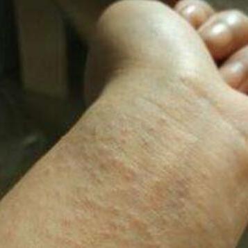 酒精过敏怎么快速缓解:酒精过敏急救指南,快速缓解症状,保障健康安全 酒精过敏怎么快速缓解:酒精过敏急救指南,快速缓解症状,保障健康安全