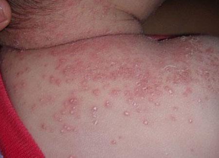 湿疹长什么样一般长在哪里:认识湿疹,它长什么样?通常长在哪些地方? 湿疹长什么样一般长在哪里:认识湿疹,它长什么样?通常长在哪些地方?