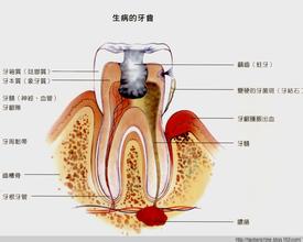 上火牙痛和牙髓炎的区别:上火牙痛VS牙髓炎,你真的分得清吗? 上火牙痛和牙髓炎的区别:上火牙痛VS牙髓炎,你真的分得清吗?