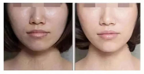 1个疣体激光一次多少钱:1个疣体激光一次多少钱?费用受哪些因素影响? 1个疣体激光一次多少钱:1个疣体激光一次多少钱?费用受哪些因素影响?