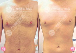 1个疣体激光一次多少钱:1个疣体激光一次多少钱?费用受哪些因素影响? 1个疣体激光一次多少钱:1个疣体激光一次多少钱?费用受哪些因素影响?