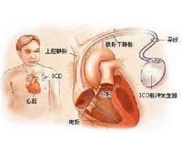 窦性心动过速会自愈吗:窦性心动过速会自愈吗?答案在这里! 窦性心动过速会自愈吗:窦性心动过速会自愈吗?答案在这里!