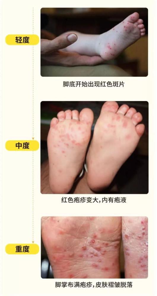 小孩口足手病轻微图片：小孩口足手病轻微症状及家庭护理指南