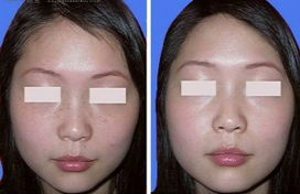 色斑怎么去除掉:彻底告别烦人色斑,这些方法你一定要知道! 色斑怎么去除掉:彻底告别烦人色斑,这些方法你一定要知道!