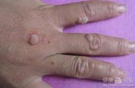 扁平疣最简单的去除方法:扁平疣最简单的去除方法,民间偏方与医学手段大解析 扁平疣最简单的去除方法:扁平疣最简单的去除方法,民间偏方与医学手段大解析