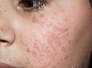 扁平疣最简单的去除方法:扁平疣最简单的去除方法,民间偏方与医学手段大解析 扁平疣最简单的去除方法:扁平疣最简单的去除方法,民间偏方与医学手段大解析