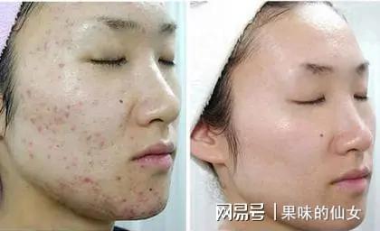 用什么方法去除痘印最有效最快：用什么方法去除痘印最有效最快？科学解析与实用方案