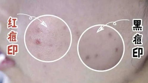 用什么方法去除痘印最有效最快：用什么方法去除痘印最有效最快？科学解析与实用方案