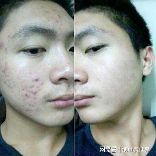 用什么方法去除痘印最有效最快：用什么方法去除痘印最有效最快？科学解析与实用方案