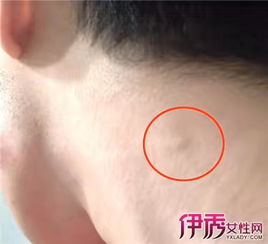 淋巴结肿大吃什么药:淋巴结肿大不能随便吃药,这些药千万别乱用! 淋巴结肿大吃什么药:淋巴结肿大不能随便吃药,这些药千万别乱用!