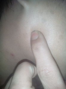 淋巴结肿大吃什么药:淋巴结肿大不能随便吃药,这些药千万别乱用! 淋巴结肿大吃什么药:淋巴结肿大不能随便吃药,这些药千万别乱用!