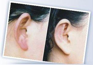 精灵耳整形多少钱:精灵耳整形多少钱?揭秘价格与注意事项,助你做出明智选择! 精灵耳整形多少钱:精灵耳整形多少钱?揭秘价格与注意事项,助你做出明智选择!