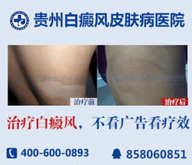 有名的皮肤病医院:全国最好的皮肤病医院是哪家?国内顶尖皮肤病医院全解析! 有名的皮肤病医院:全国最好的皮肤病医院是哪家?国内顶尖皮肤病医院全解析!