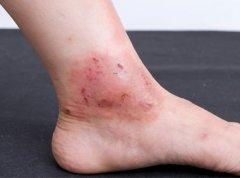 有名的皮肤病医院:全国最好的皮肤病医院是哪家?国内顶尖皮肤病医院全解析! 有名的皮肤病医院:全国最好的皮肤病医院是哪家?国内顶尖皮肤病医院全解析!