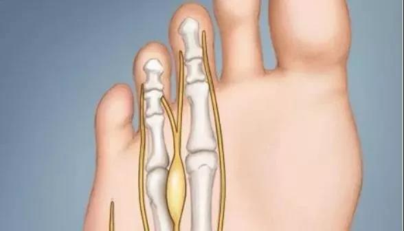 神经紊乱全身游走性疼痛:神经紊乱与全身游走性疼痛,症状、原因与应对策略 神经紊乱全身游走性疼痛:神经紊乱与全身游走性疼痛,症状、原因与应对策略