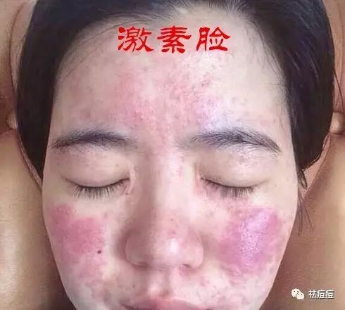 脸有红血丝怎么修复:脸有红血丝怎么修复?全面指南,从根源改善红血丝困扰 脸有红血丝怎么修复:脸有红血丝怎么修复?全面指南,从根源改善红血丝困扰