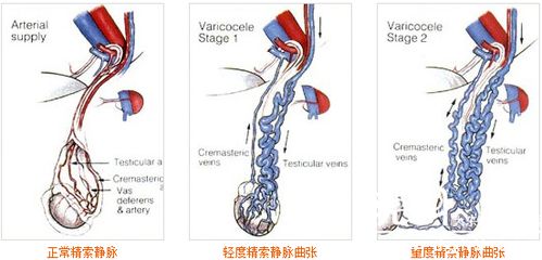 十个当兵九个精索静脉曲张:十个当兵九个精索静脉曲张?真相在这里! 十个当兵九个精索静脉曲张:十个当兵九个精索静脉曲张?真相在这里!
