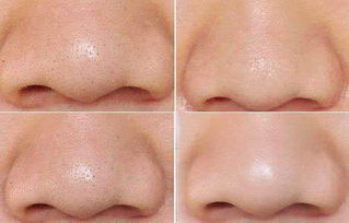 清理黑头最有效的方法:彻底清除烦恼黑头,5个最有效方法,还你细腻光滑肌肤! 清理黑头最有效的方法:彻底清除烦恼黑头,5个最有效方法,还你细腻光滑肌肤!