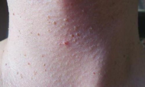 阴囊唇内侧长了个小肉粒图片：阴囊唇内侧长了个小肉粒？可能是这些原因，建议及时就医检查