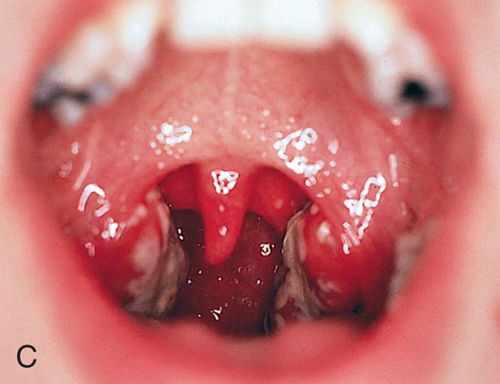 扁桃体变长了挂到喉咙下了:扁桃体长了?悬在喉咙下方,原来是这样回事! 扁桃体变长了挂到喉咙下了:扁桃体长了?悬在喉咙下方,原来是这样回事!