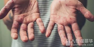 手足口病会传染大人么:手足口病会传染大人么? 手足口病会传染大人么:手足口病会传染大人么?