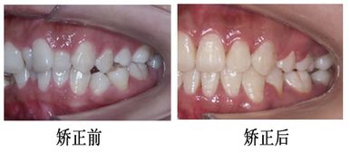 正规医院补牙多少钱一颗:正规医院补牙价格解析,从几百到上千,这些因素决定你的账单 正规医院补牙多少钱一颗:正规医院补牙价格解析,从几百到上千,这些因素决定你的账单