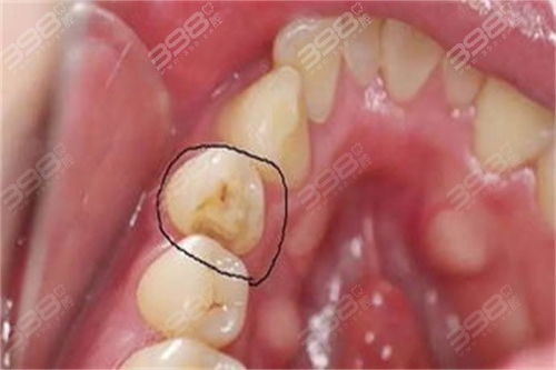 正规医院补牙多少钱一颗:正规医院补牙价格解析,从几百到上千,这些因素决定你的账单 正规医院补牙多少钱一颗:正规医院补牙价格解析,从几百到上千,这些因素决定你的账单