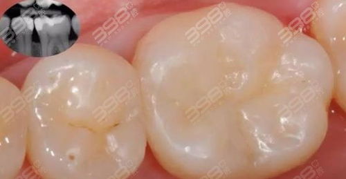 正规医院补牙多少钱一颗:正规医院补牙价格解析,从几百到上千,这些因素决定你的账单 正规医院补牙多少钱一颗:正规医院补牙价格解析,从几百到上千,这些因素决定你的账单