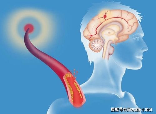 脑供血不足吃啥补得快:脑供血不足吃啥补得快?这5种食物要多吃! 脑供血不足吃啥补得快:脑供血不足吃啥补得快?这5种食物要多吃!