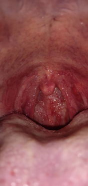 咽喉发炎最快治愈法：咽喉发炎最快治愈法，黄金24小时缓解不适的家庭疗法