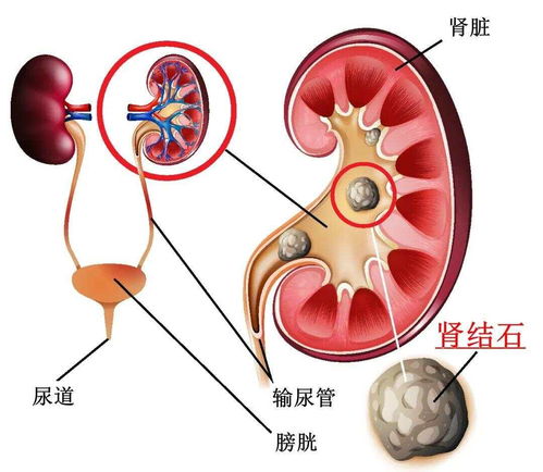 一招排出肾结石最快方法:一招排出肾结石最快方法?这些科学方法更靠谱! 一招排出肾结石最快方法:一招排出肾结石最快方法?这些科学方法更靠谱!