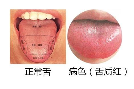 正常人上火的舌头图片:警惕!这些舌象变化可能是身体上火的信号,正常人该如何应对? 正常人上火的舌头图片:警惕!这些舌象变化可能是身体上火的信号,正常人该如何应对?