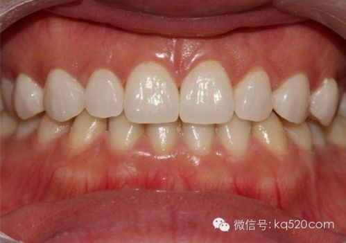 目前最先进的活动义齿:活动义齿的革命性突破,最新技术重塑口腔修复新标准 目前最先进的活动义齿:活动义齿的革命性突破,最新技术重塑口腔修复新标准