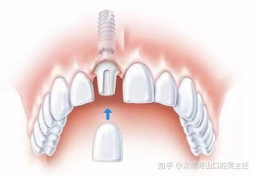 目前最先进的活动义齿:活动义齿的革命性突破,最新技术重塑口腔修复新标准 目前最先进的活动义齿:活动义齿的革命性突破,最新技术重塑口腔修复新标准
