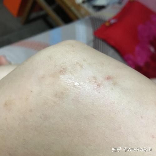 晚上荨麻疹最快止痒：晚上荨麻疹最快止痒方法，夜间来袭也能快速缓解！