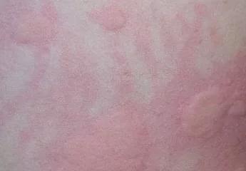 晚上荨麻疹最快止痒：晚上荨麻疹最快止痒方法，夜间来袭也能快速缓解！