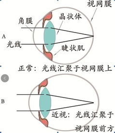 怎么让视力慢慢恢复:守护明亮视界,科学方法助你逐步改善视力 怎么让视力慢慢恢复:守护明亮视界,科学方法助你逐步改善视力