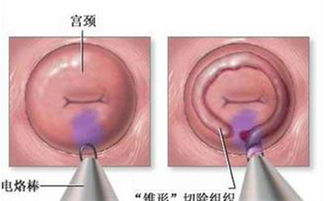宫颈息肉需要做手术吗:宫颈息肉需要做手术吗?权威解读手术与否的关键因素 宫颈息肉需要做手术吗:宫颈息肉需要做手术吗?权威解读手术与否的关键因素