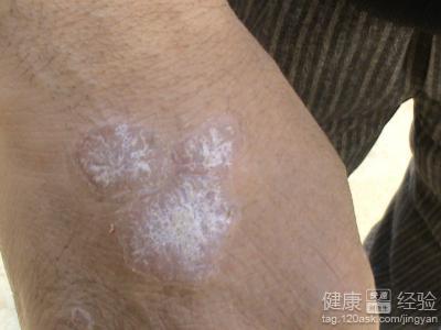 甘草酸苷银屑病多久见效:甘草酸苷治疗银屑病多久见效?时间范围与影响因素全解析 甘草酸苷银屑病多久见效:甘草酸苷治疗银屑病多久见效?时间范围与影响因素全解析