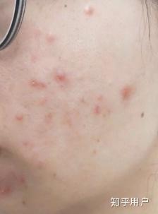 不吃药阳瘘会自己恢复吗:不用药,阳痿会自己恢复吗? 不吃药阳瘘会自己恢复吗:不用药,阳痿会自己恢复吗?