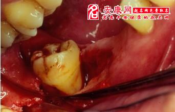 梦见牙齿脱落流血:解密噩梦,牙齿脱落流血背后的隐藏信息 梦见牙齿脱落流血:解密噩梦,牙齿脱落流血背后的隐藏信息