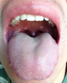 阴虚内热的症状:阴虚内热的症状有哪些? 阴虚内热的症状:阴虚内热的症状有哪些?