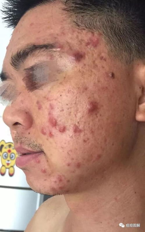 毛囊炎最简单自愈方法小妙招:毛囊炎困扰?这几个简单小妙招助你轻松自愈! 毛囊炎最简单自愈方法小妙招:毛囊炎困扰?这几个简单小妙招助你轻松自愈!