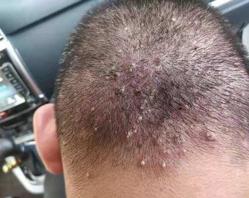 毛囊炎最简单自愈方法小妙招:毛囊炎困扰?这几个简单小妙招助你轻松自愈! 毛囊炎最简单自愈方法小妙招:毛囊炎困扰?这几个简单小妙招助你轻松自愈!