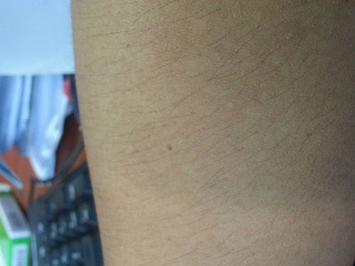 毛囊炎最简单自愈方法小妙招:毛囊炎困扰?这几个简单小妙招助你轻松自愈! 毛囊炎最简单自愈方法小妙招:毛囊炎困扰?这几个简单小妙招助你轻松自愈!