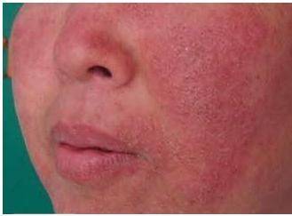 肤轻松对哪些皮肤病有疗效:肤轻松对哪些皮肤病有疗效? 肤轻松对哪些皮肤病有疗效:肤轻松对哪些皮肤病有疗效?