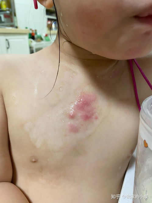 深二度烫伤疤痕图片:深二度烫伤疤痕的特征与识别,你需要了解的一切 深二度烫伤疤痕图片:深二度烫伤疤痕的特征与识别,你需要了解的一切