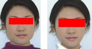 现在瘦脸针一般是多少钱一针:瘦脸针价格大揭秘,多少钱一针?你真的需要知道这些! 现在瘦脸针一般是多少钱一针:瘦脸针价格大揭秘,多少钱一针?你真的需要知道这些!