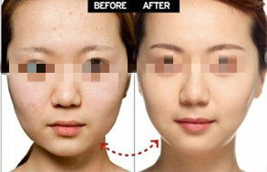 现在瘦脸针一般是多少钱一针:瘦脸针价格大揭秘,多少钱一针?你真的需要知道这些! 现在瘦脸针一般是多少钱一针:瘦脸针价格大揭秘,多少钱一针?你真的需要知道这些!