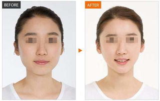 现在瘦脸针一般是多少钱一针:瘦脸针价格大揭秘,多少钱一针?你真的需要知道这些! 现在瘦脸针一般是多少钱一针:瘦脸针价格大揭秘,多少钱一针?你真的需要知道这些!